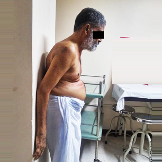 Ankylosing-Spondylitis