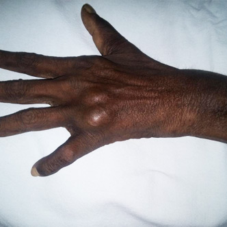 Ankylosing-Spondylitis